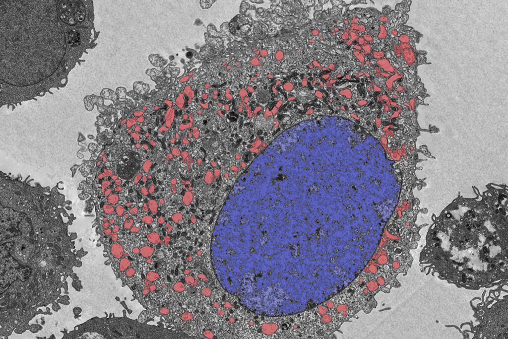 Two new studies from Washington University School of Medicine in St. Louis have identified a previously unrecognized pathway of cell death — named lysoptosis — and demonstrate how it could lead to new therapies for cervical cancer. Pictured is a human cervical cancer cell that is undergoing lysoptosis triggered by radiation. The cell is missing a key gene that protects against this type of cell death, making the cell easier to kill with radiation and chemotherapy. Lysosomes are shown in red. The cell nucleus is in blue.