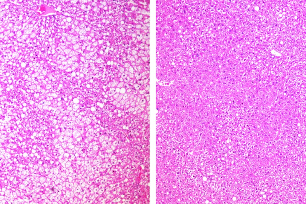 An investigational cancer drug that starves tumors of their energy supply also shows evidence of improving whole body metabolism, according to a new study in mice from Washington University School of Medicine in St. Louis. Shown are sections of liver from mice on a high-fat, high-sugar diet. On the left, more white space indicates greater fat accumulation in an untreated mouse. On the right, in a mouse treated with the drug, the liver shows less fat accumulation.