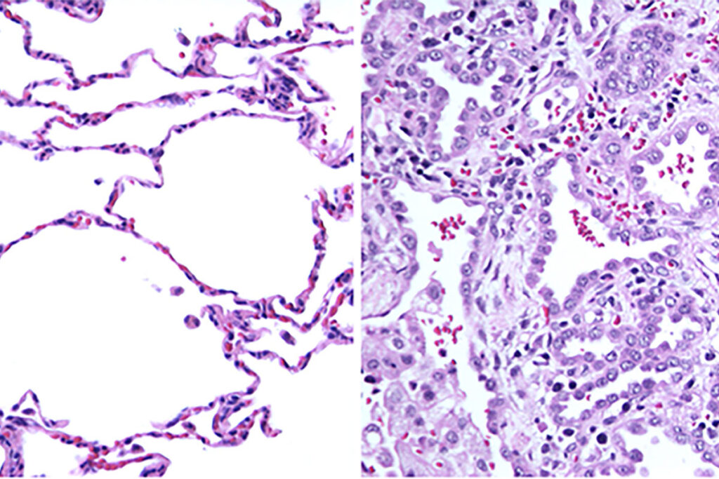 New research from Washington University School of Medicine in St. Louis has solved the medical mystery of why a 2-year-old child — seemingly healthy at birth — succumbed to an undiagnosed, rare illness. On the left is normal lung tissue showing air sacs with thin cell layers for the exchange of oxygen and carbon dioxide. On the right is the patient's lung tissue. Because of a mutation in the RAB5B gene, the walls of the air sacs are thick and unable to participate in gas transfer.