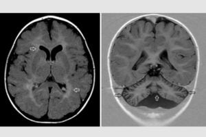 Researchers at WashU Medicine collaborated with an international team of doctors and scientists to identify the cause of a rare disorder involving intellectual disability and brain malformations. Brain scans from a patient with this disorder reveal atypical features in white matter (arrows, left) and the cerebellum (arrows, right).