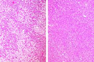 An investigational cancer drug that starves tumors of their energy supply also shows evidence of improving whole body metabolism, according to a new study in mice from Washington University School of Medicine in St. Louis. Shown are sections of liver from mice on a high-fat, high-sugar diet. On the left, more white space indicates greater fat accumulation in an untreated mouse. On the right, in a mouse treated with the drug, the liver shows less fat accumulation.