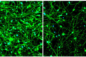 A study from Washington University School of Medicine in St. Louis shows that as patients age, Huntington's disease impairs autophagy, which eliminates waste from cells. Shown at left are neurons transformed from skin cells of a young patient with pre-symptomatic Huntington's disease. On the right are neurons transformed from skin cells of an older patient with symptomatic Huntington's; these cells are sparse because the aging process impairs autophagy, leading to cell death.